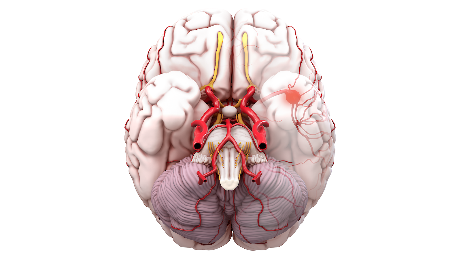 Unteransicht des Gehirns für die Lokalisation des Aneurysmas.